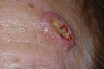 dermahealth-carcinoma-espinocelular