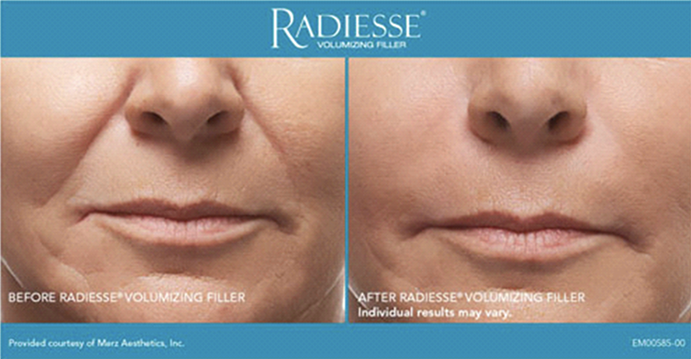 dermahealth-radiesse