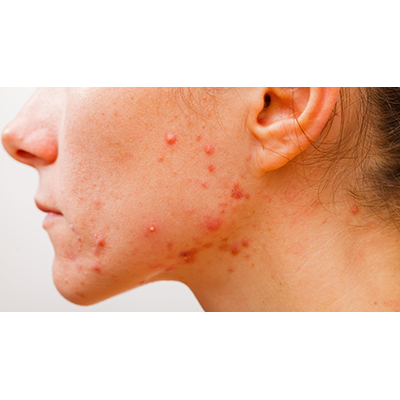 dermahealt-dermatologia-acne-3