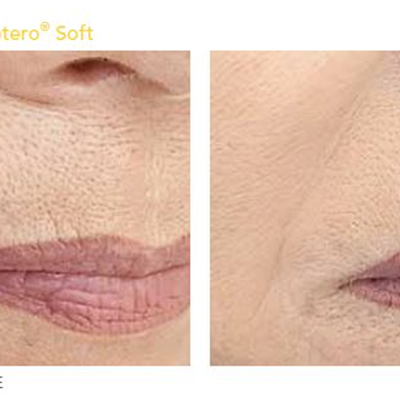 dermahealth-belotero-soft