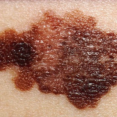 dermahealth-melanoma