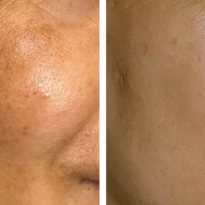 dermahealth-melasma