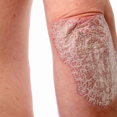 dermahealth-psoriasis