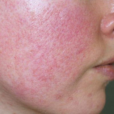 dermahealth-rosacea